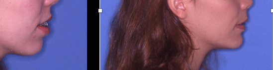 Chin Augmentation case study, before and after photos
