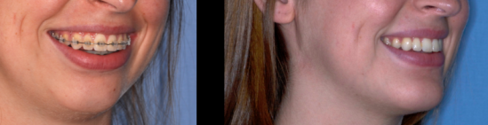 Chin Augmentation case study, before and after photos