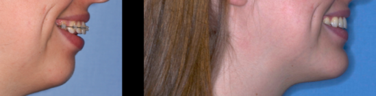 Chin Augmentation case study, before and after photos