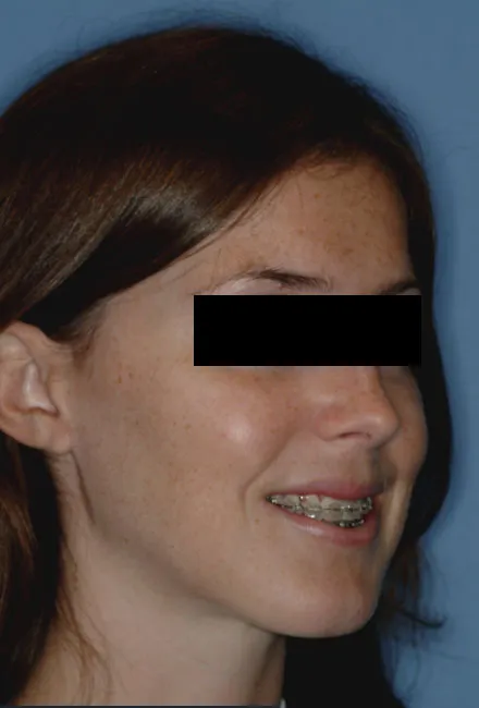After Jaw Surgery