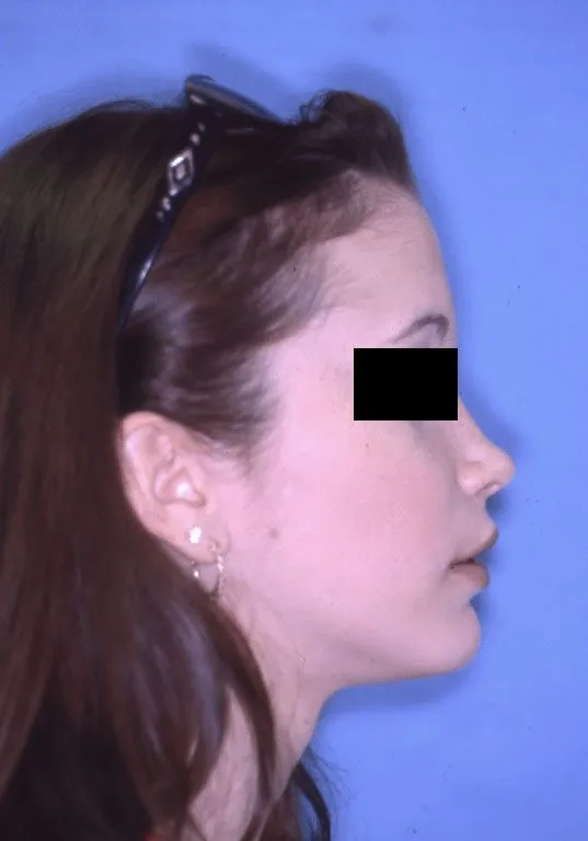 After Jaw Surgery