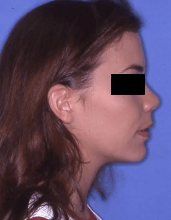 After Jaw Surgery