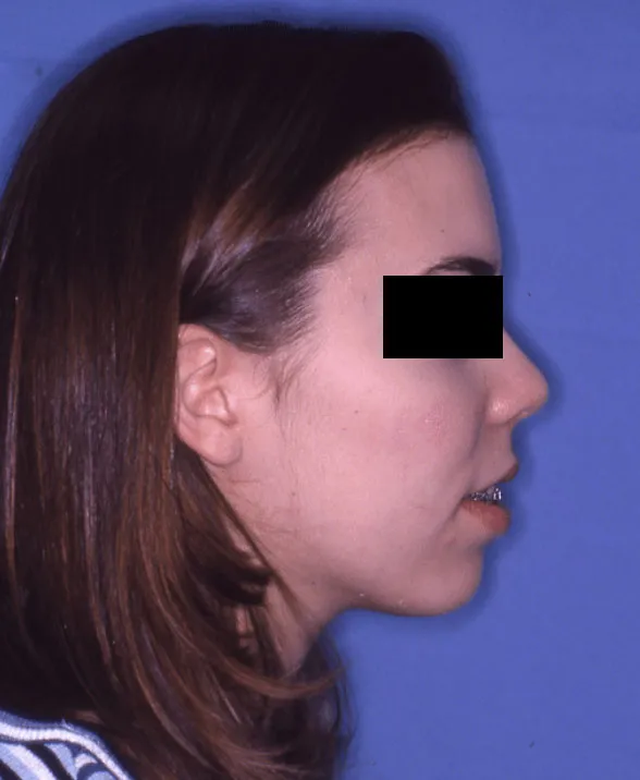 Before Jaw Surgery