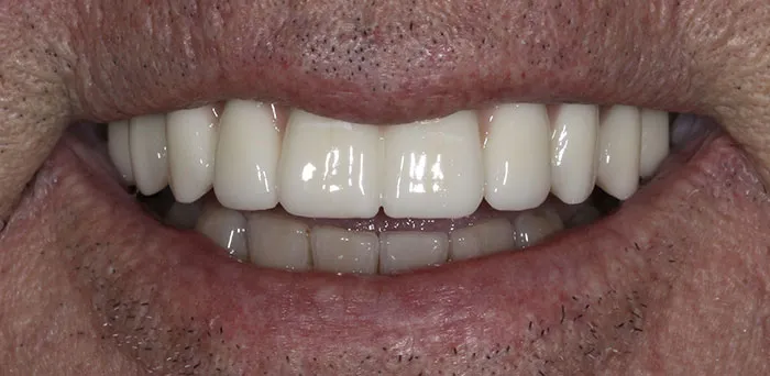 Dental Implant Case