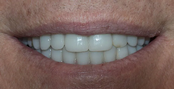 Dental Implant Case