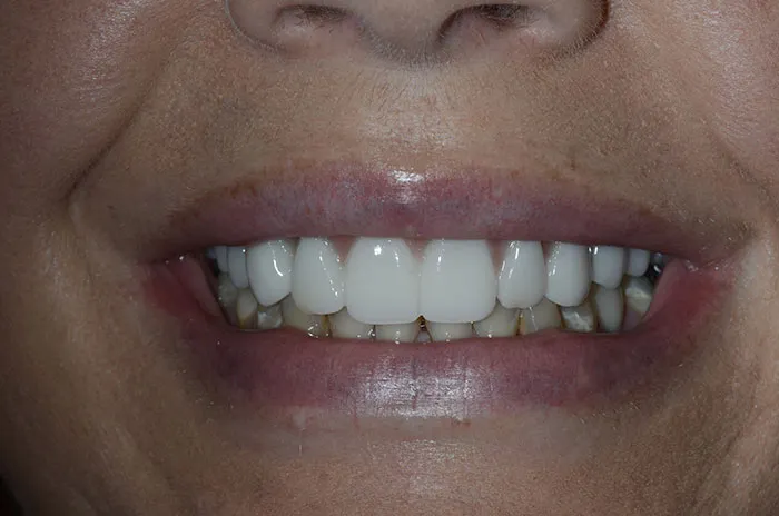 Dental Implant Case