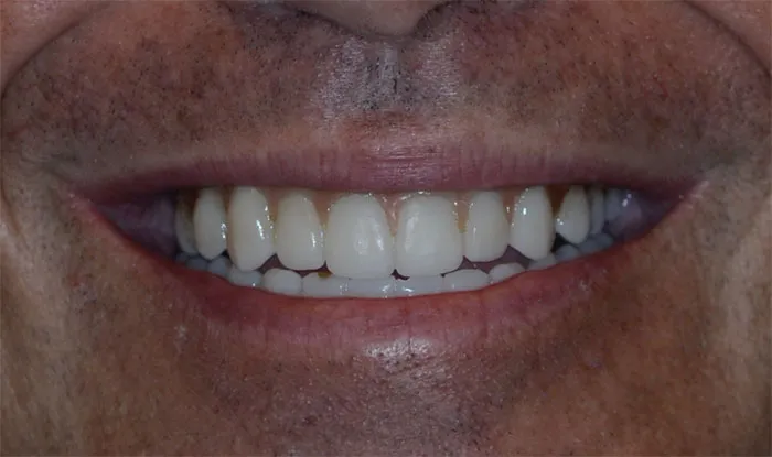 Dental Implant Case