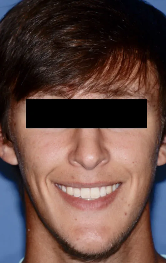 After Jaw Surgery