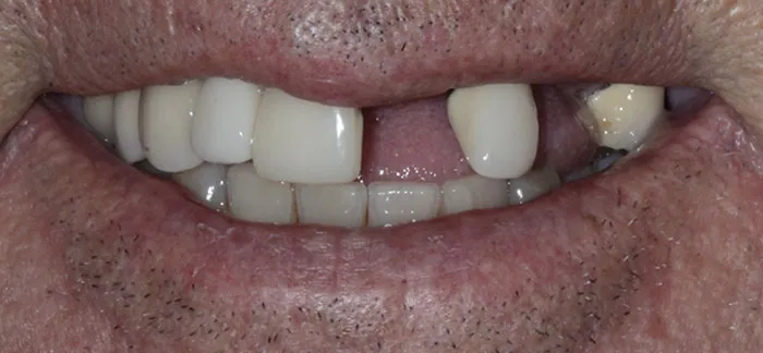 Dental Implant Case