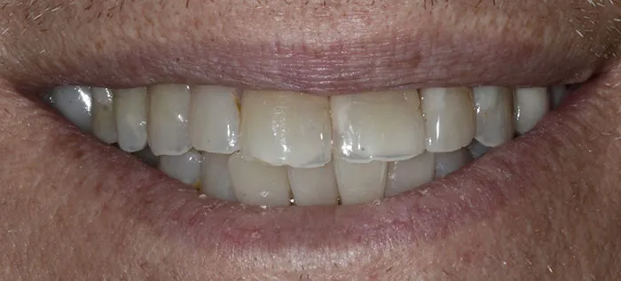 Dental Implant Case