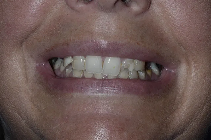 Dental Implant Case