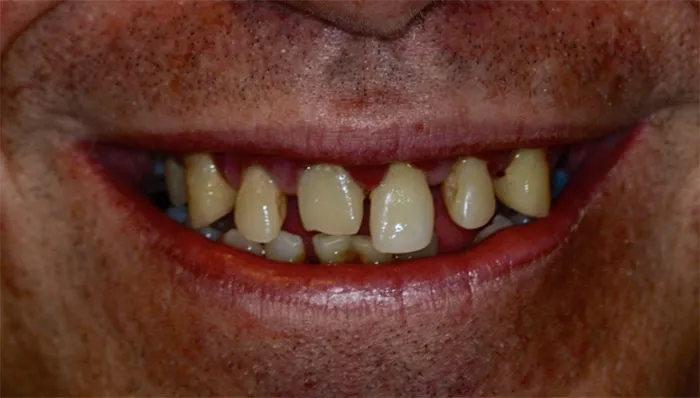 Dental Implant Case