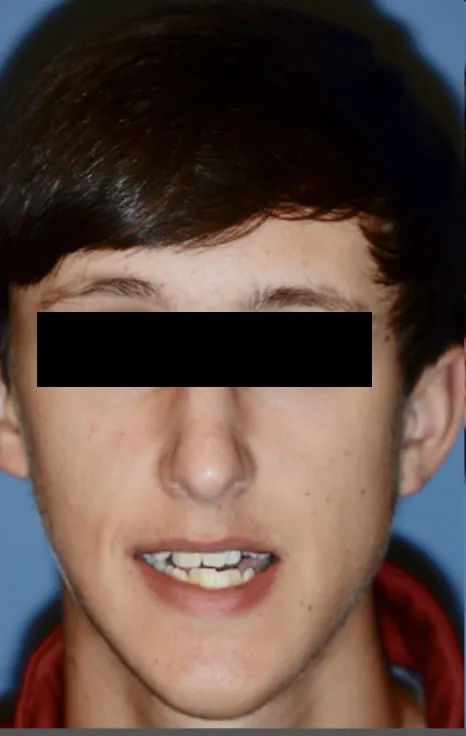 Before Jaw Surgery