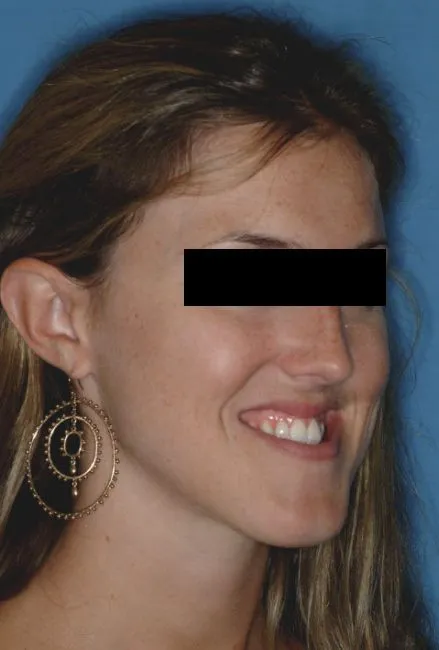Before Jaw Surgery