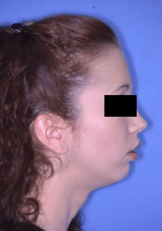 Before Jaw Surgery