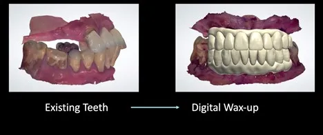 Existing Teeth and Digital Wax-up