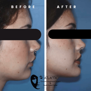 Before and After Jaw Surgery