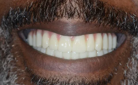 After Dental Implants
