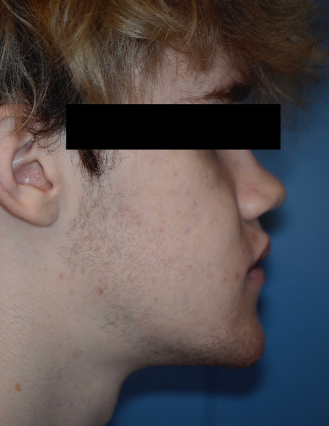 After Jaw Surgery
