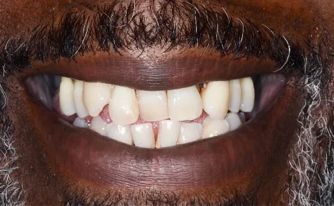 Before Dental Implants