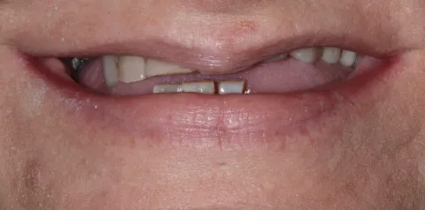 Before Dental Implants