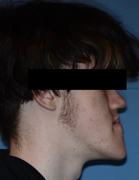 Before Jaw Surgery