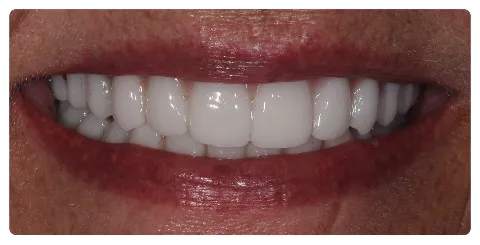 After Dental Implants