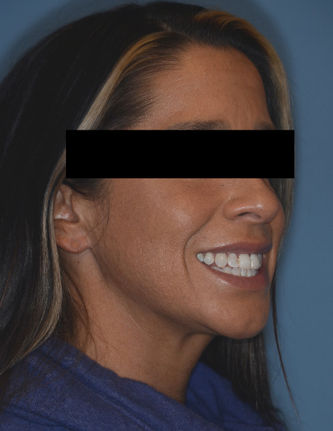 After Jaw Surgery