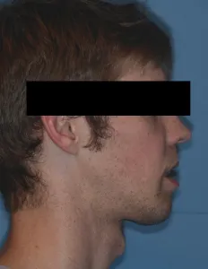 After Jaw Surgery