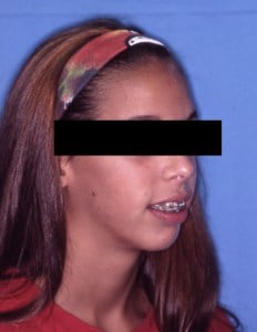 Before Jaw Surgery