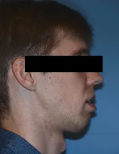 Before Jaw Surgery