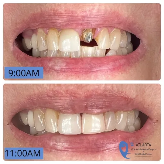 Before and after emergency tooth extraction - within 2 hours, a new tooth