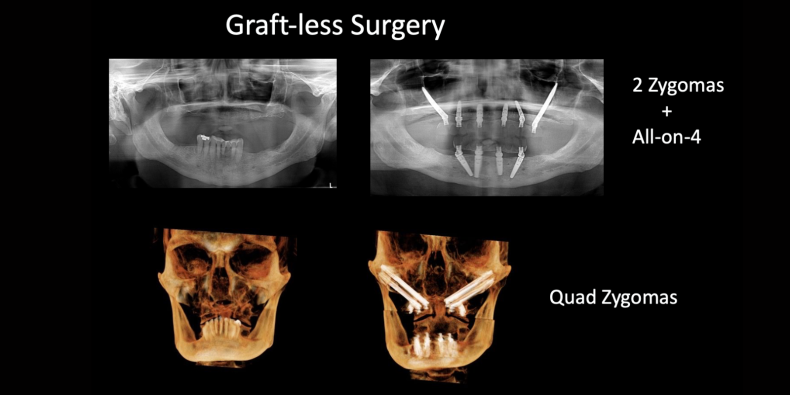 Zygomatic Implants & Graftless Surgery Illustration