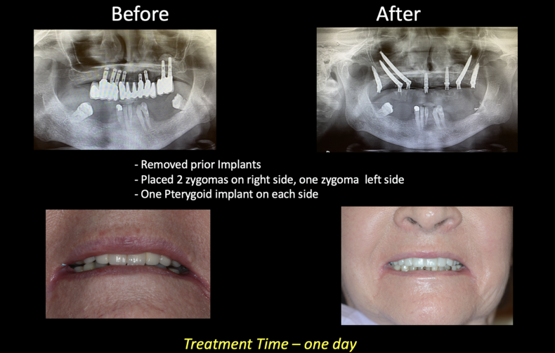 Zygomatic Implants & Graftless Surgery Illustration