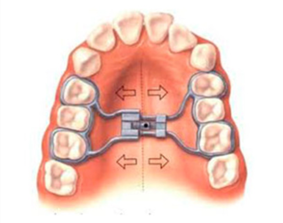 Palatal Matrix N Alpharetta GA, Atlanta Oral & Maxillofacial Surgery and Dental ...