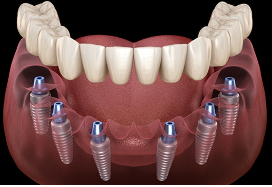 Same Day Teeth Alpharetta Full Arch Dental Implants