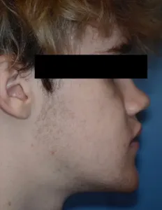 After Jaw Surgery