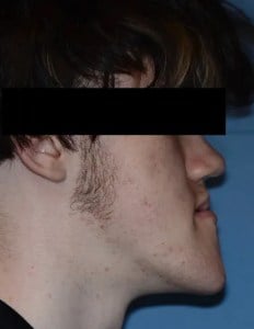 Before Jaw Surgery