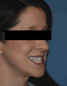 Before Jaw Surgery
