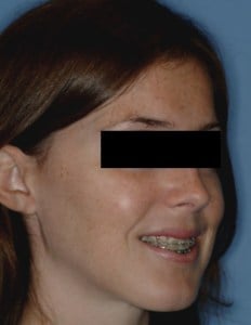 After Jaw Surgery