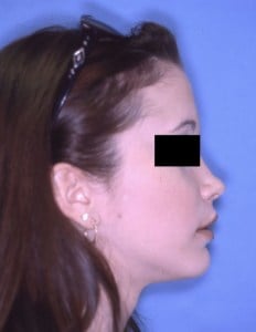 After Jaw Surgery