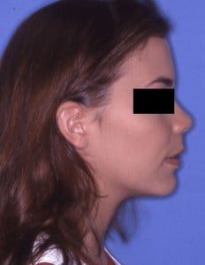 After Jaw Surgery