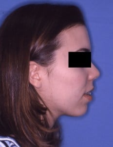 Before Jaw Surgery