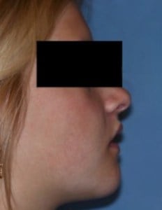 After Jaw Surgery