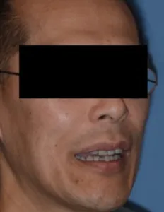 After Jaw Surgery