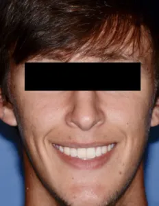 After Jaw Surgery