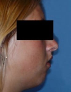 Before Jaw Surgery
