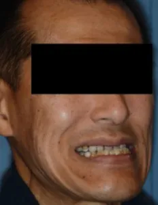 Before Jaw Surgery
