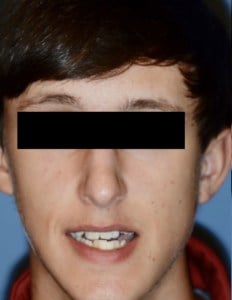 Before Jaw Surgery