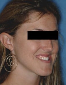 Before Jaw Surgery